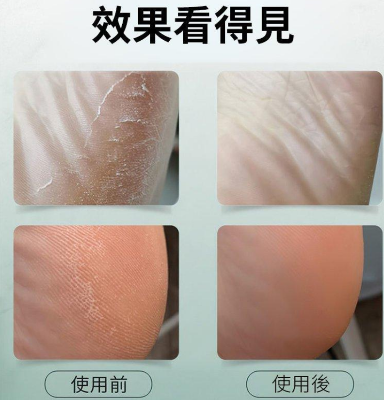 德國西門子充電式電動修腳器 磨腳皮去腳皮死皮刀老繭磨腳神器修足機 德國西門子充電式電動修腳器 磨腳皮去腳皮死皮刀老繭磨腳神器修足機
